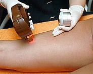 Bild zur Haarentfernung, eine Maßnahme die in die Thematik nicht-ionisierende Strahlen gehört.